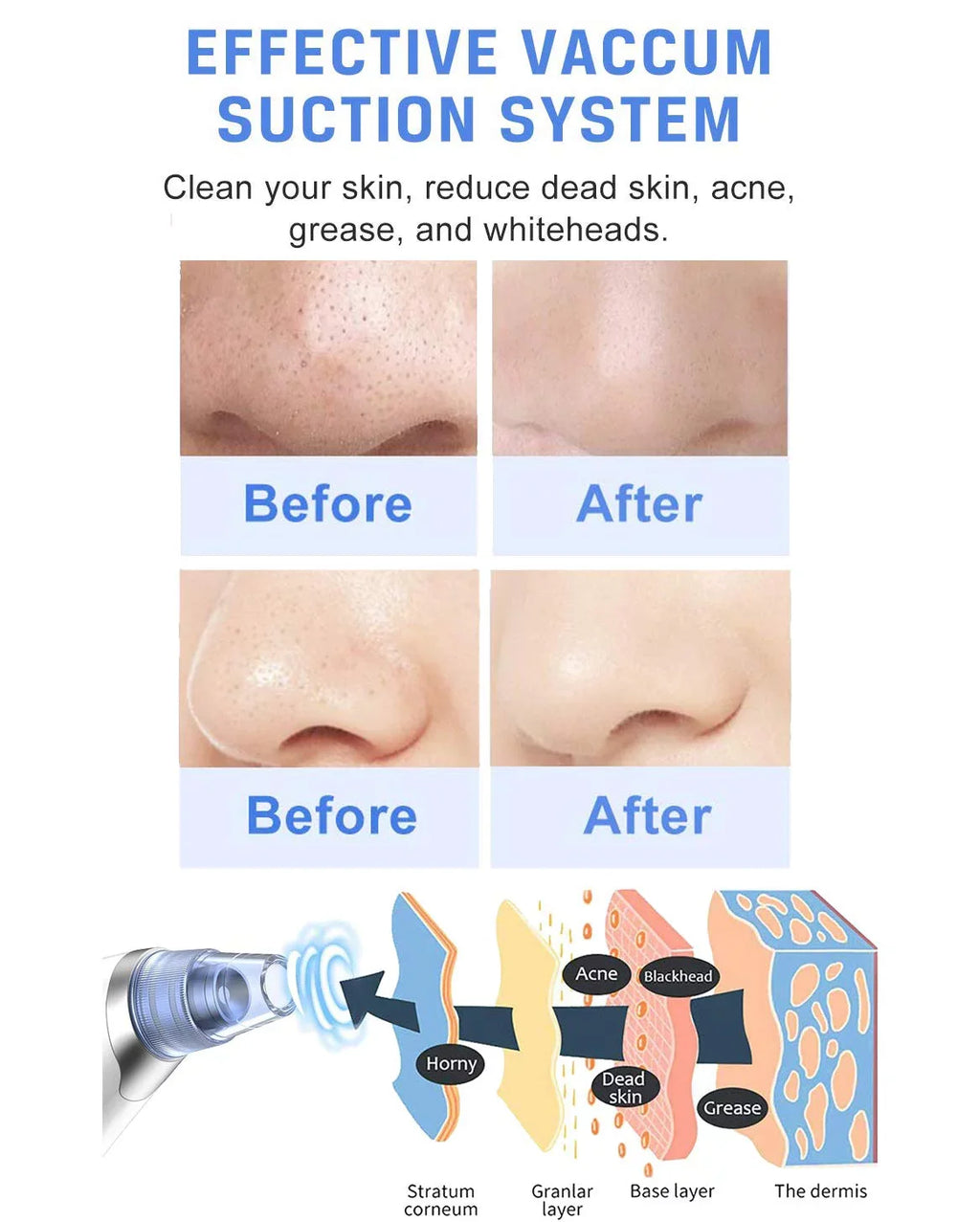 Cleaner Blackhead Pore Face USB Remover Cleaner Face Nose Rechargeable Sucker Pore Men Facial Blackhead Pore Vacuum Suction Ansten for Blackhead Electric kit Women Vacuum Remover Pimple