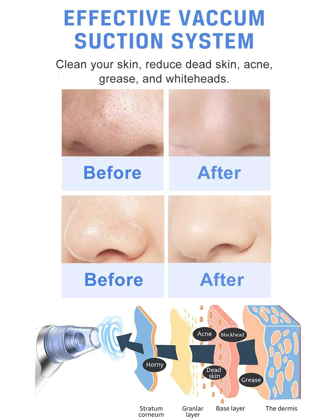 Cleaner Blackhead Pore Face USB Remover Cleaner Face Nose Rechargeable Sucker Pore Men Facial Blackhead Pore Vacuum Suction Ansten for Blackhead Electric kit Women Vacuum Remover Pimple